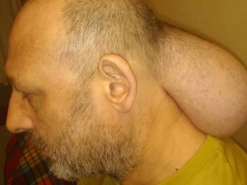 Η απάντηση του υπουργείου για τον κρατούμενο με τον τεράστιο όγκο στο κεφάλι