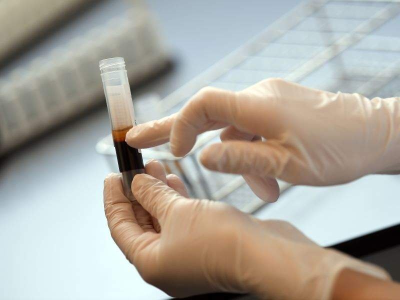 Covid-19: Οι προσδοκίες ίασης από τις μεταγγίσεις πλάσματος σύμφωνα με ερευνητή της Mayo Clinic