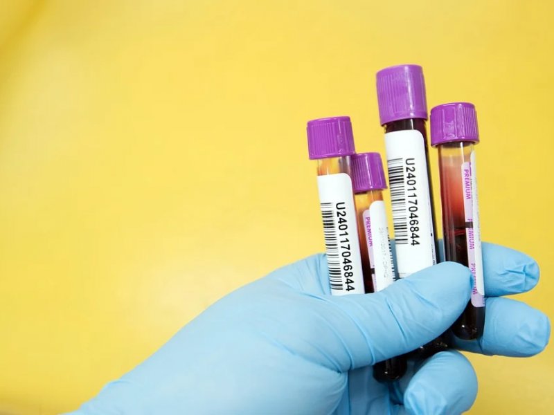 Νέο τεστ αίματος προβλέπει τον κίνδυνο εμφράγματος και εγκεφαλικού με αυξημένη ακρίβεια