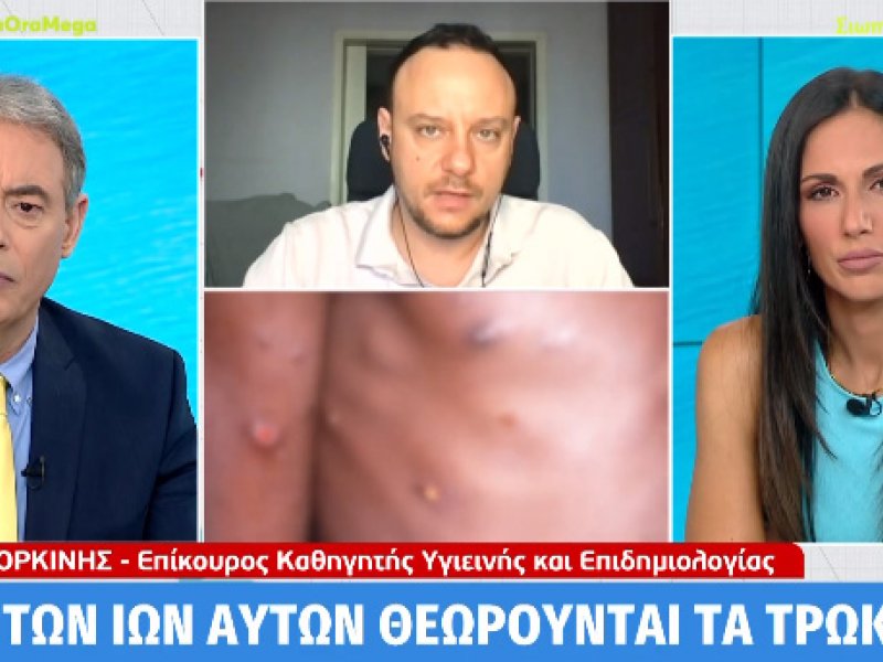 Μαγιορκίνης για την ευλογιά των πιθήκων: «Σε καμία περίπτωση δεν προβλέπεται εμβολιασμός του γενικού πληθυσμού»